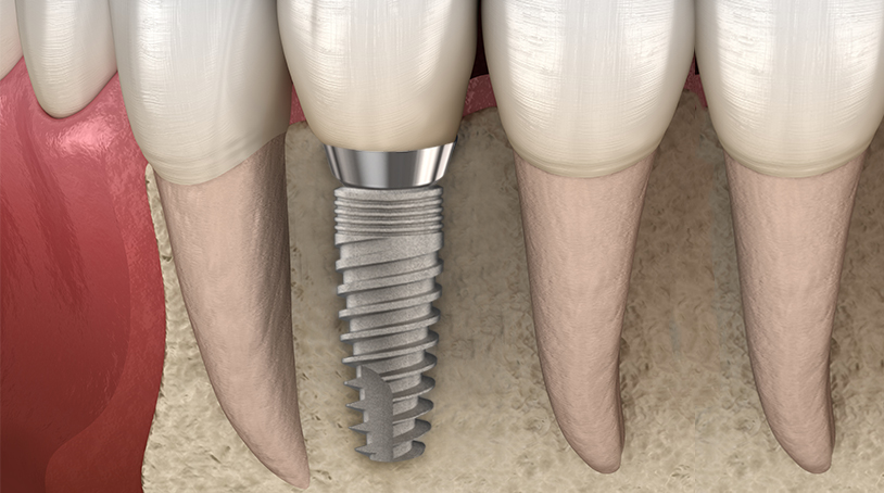 Osseointegration and the factors that affect it Osseointegration and the factors that affect it